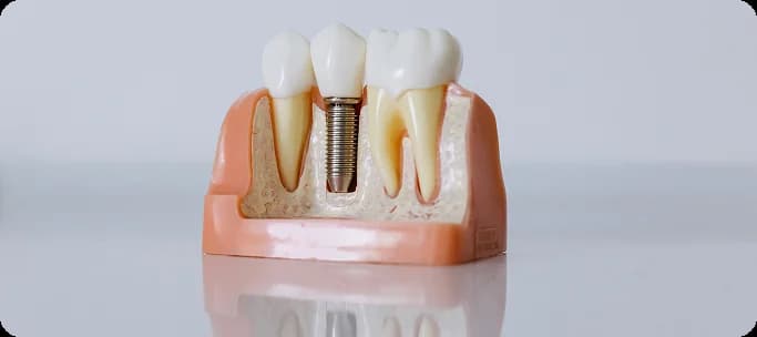 Implant dentaire remplaçant la racine d’une dent